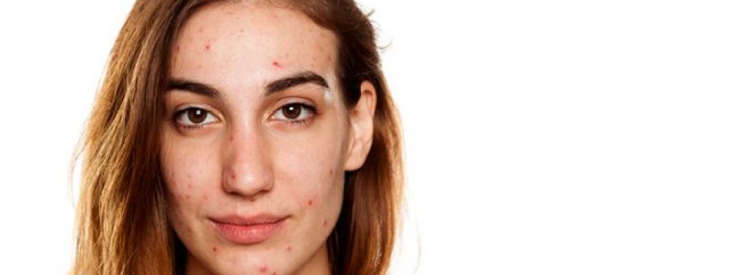 Οι διαφορετικοί τύποι ακμής: Ποιον έχετε;